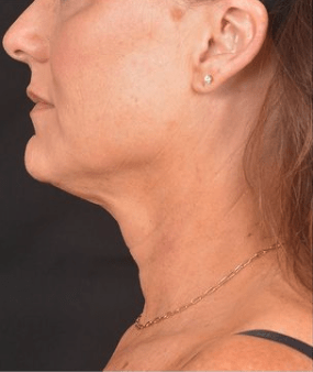 Facelift Before, undefined undefined - 1261