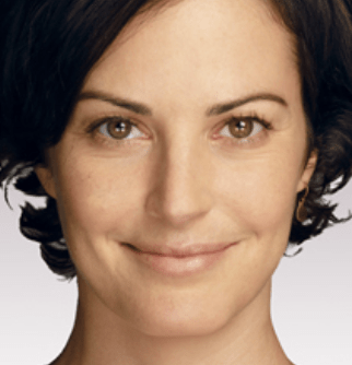 Dermal Fillers & Injectables After, undefined undefined - 1387