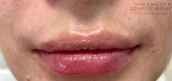 Lip Augmentation and Injections After, undefined undefined - 1703