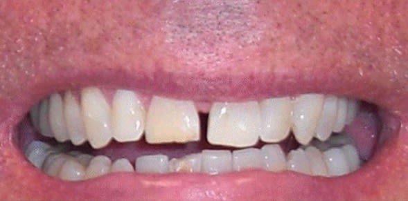 Dental Implants Before, undefined undefined - 1729