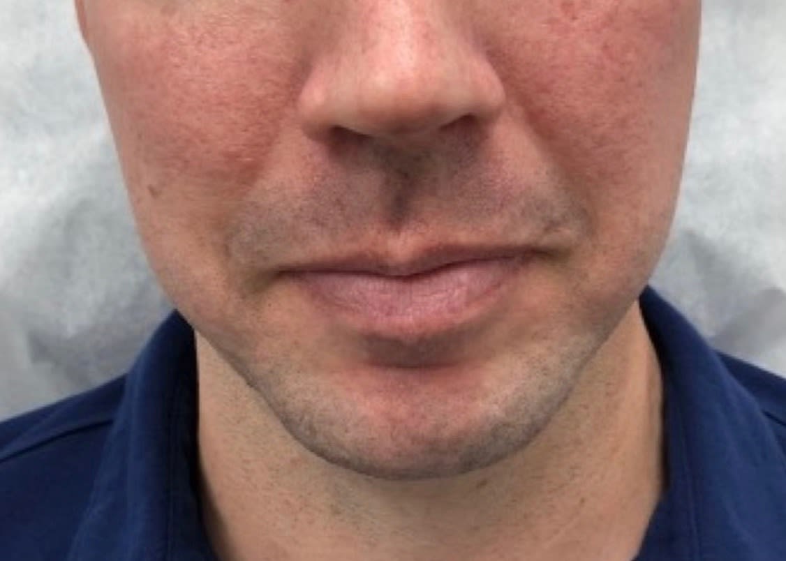 Dermal Filler & Injectable Solutions Before, undefined undefined - 1817