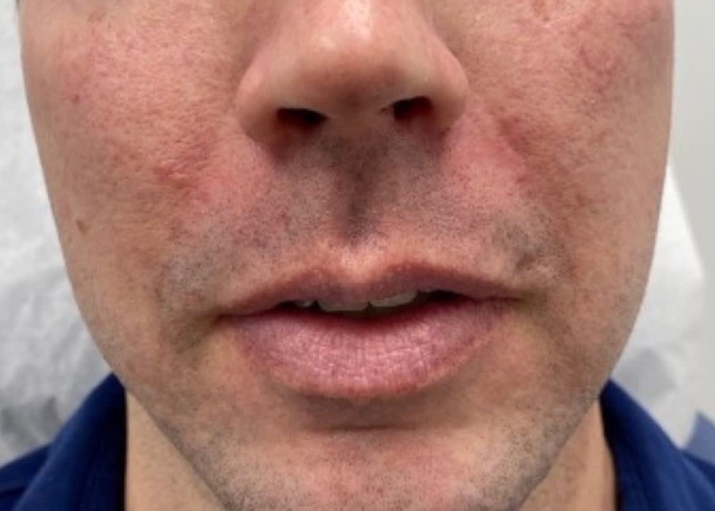 Dermal Filler & Injectable Solutions After, undefined undefined - 1817