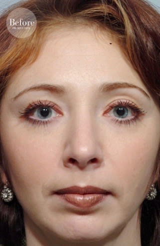 Rhinoplasty Before, undefined undefined - 1843