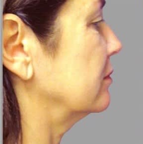Facelift Before, undefined undefined - 1930