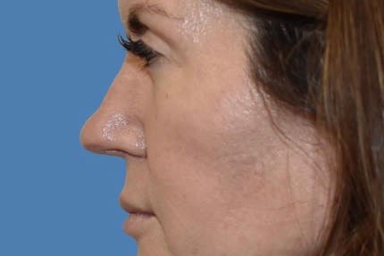 Septorhinoplasty Before, undefined undefined - 2063
