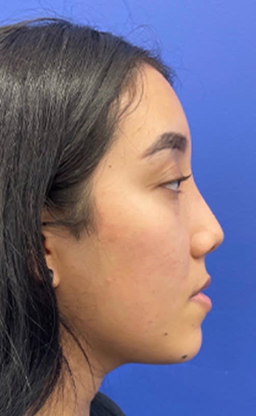 Rhinoplasty After, undefined undefined - 3070