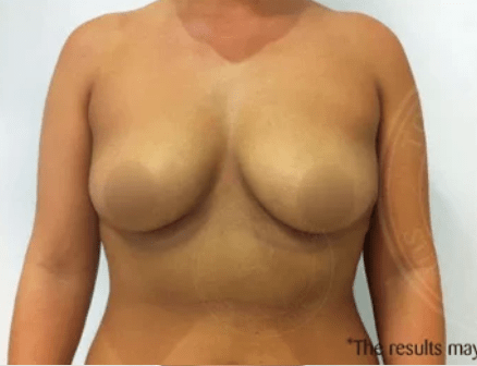 Breast Augmentation (Augmentation Mammaplasty) Before, undefined undefined - 3130