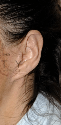 Otoplasty After, undefined undefined - 3335