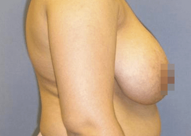 Breast Reduction & Revision Solutions Before, undefined undefined - 3456