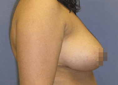 Breast Reduction & Revision Solutions After, undefined undefined - 3456