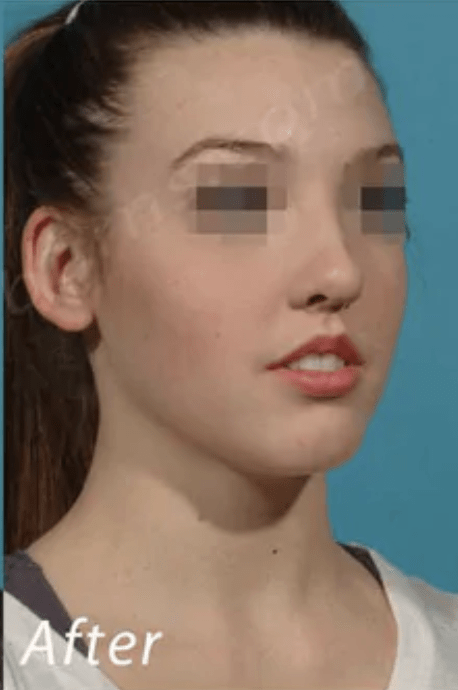 Rhinoplasty After, undefined undefined - 3554
