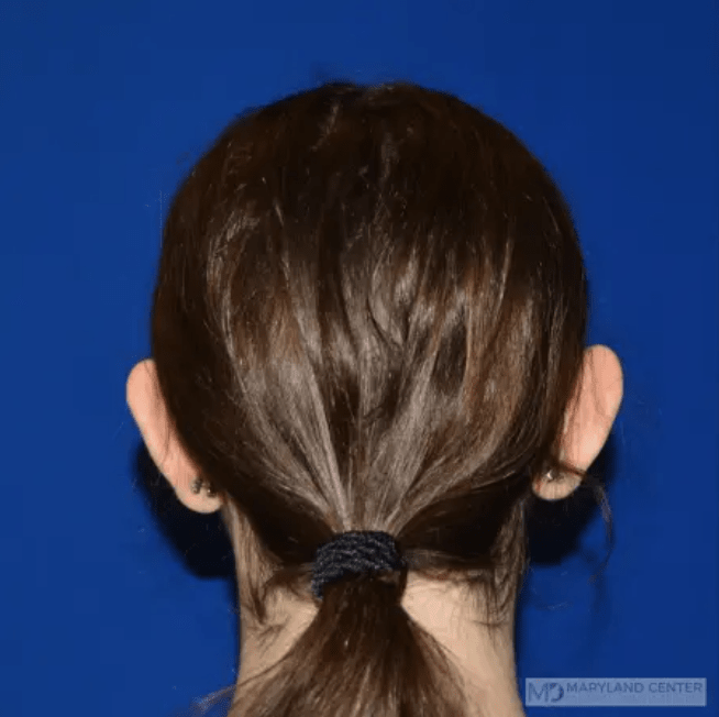 Otoplasty Before, undefined undefined - 3616