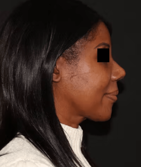 Rhinoplasty After, undefined undefined - 3619