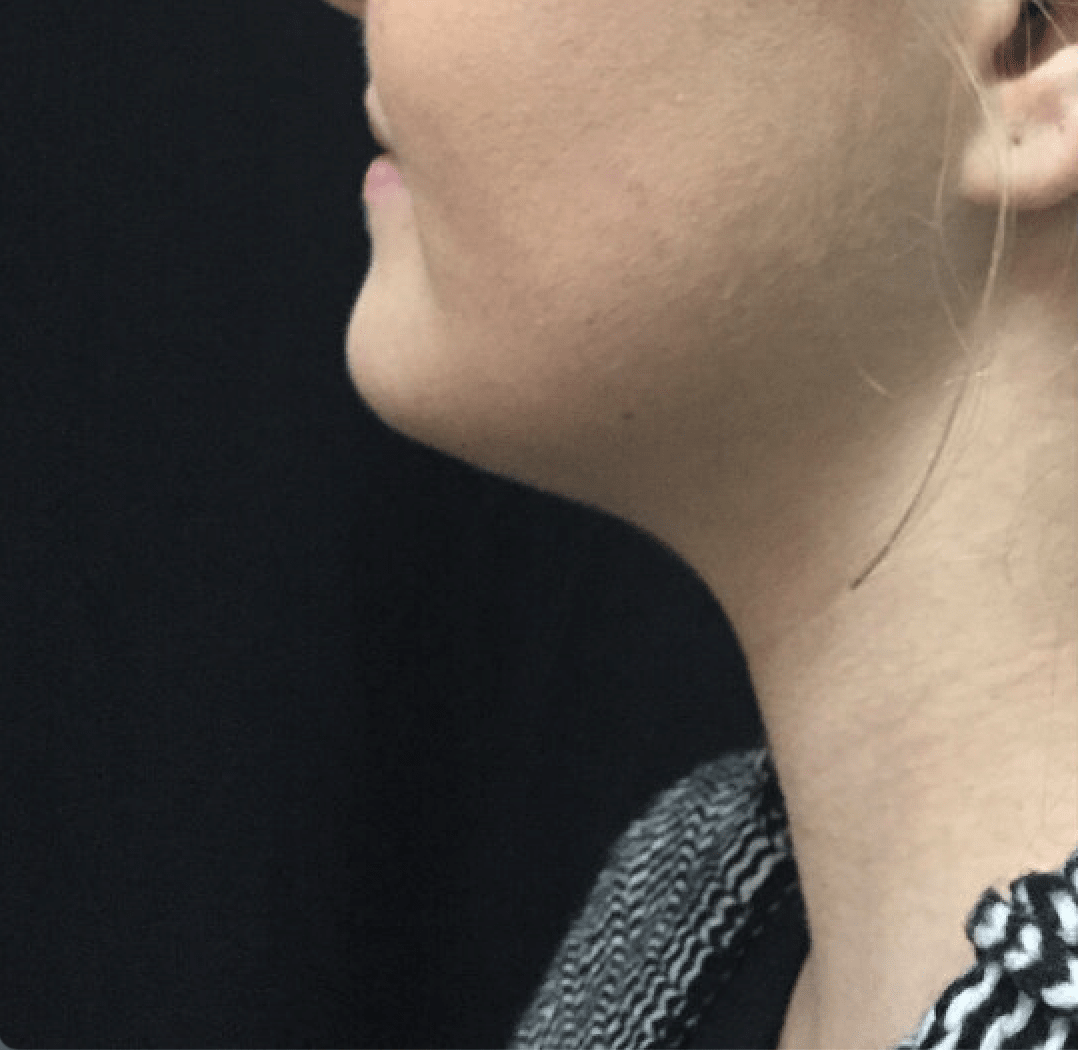 Kybella® Before, undefined undefined - 3627