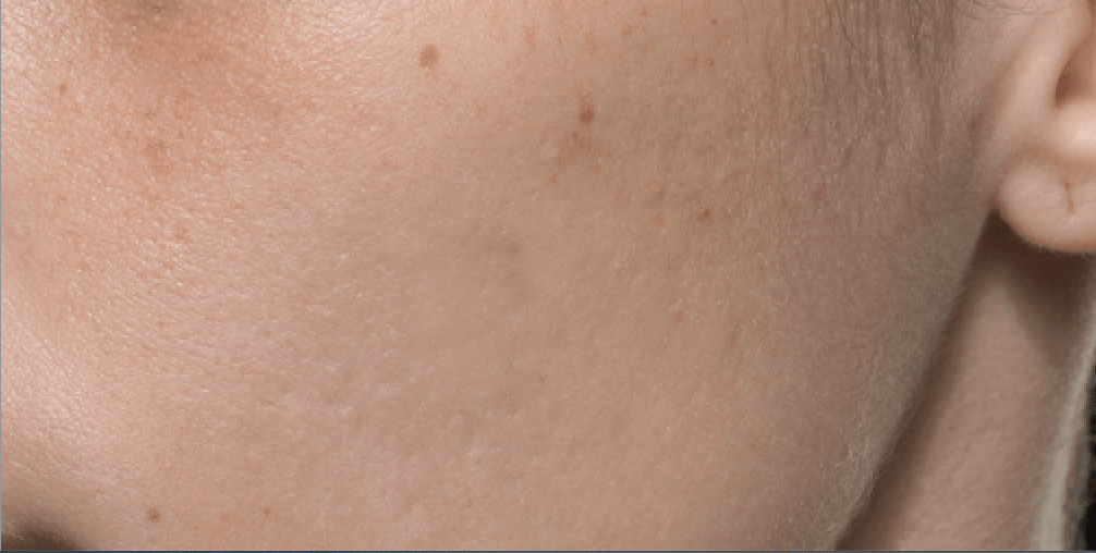 Bellafill® After, undefined undefined - 3637