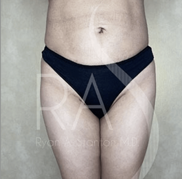 Butt Augmentation Before, undefined undefined - 3639