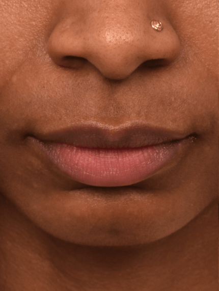 Lip Augmentation and Injections Before, undefined undefined - 3642