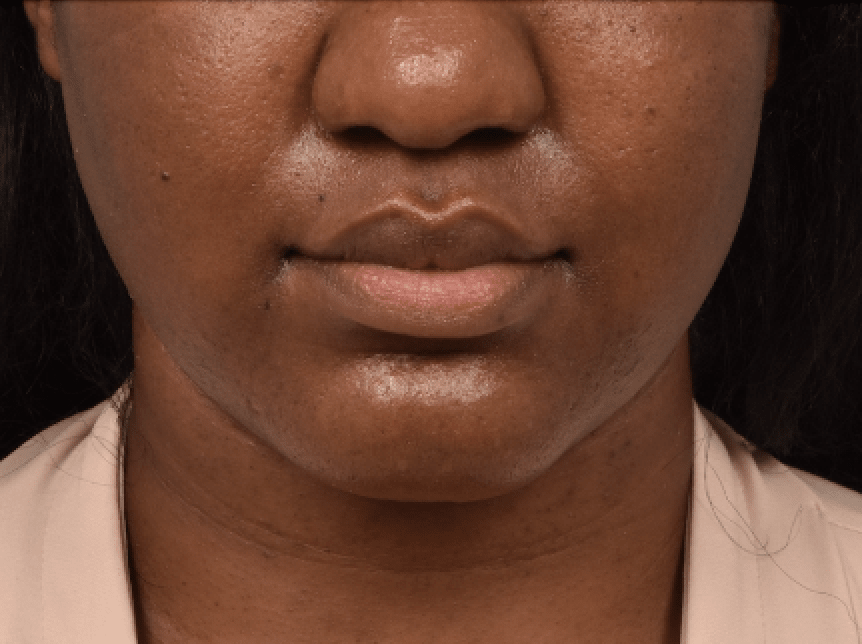Kybella® After, undefined undefined - 3643
