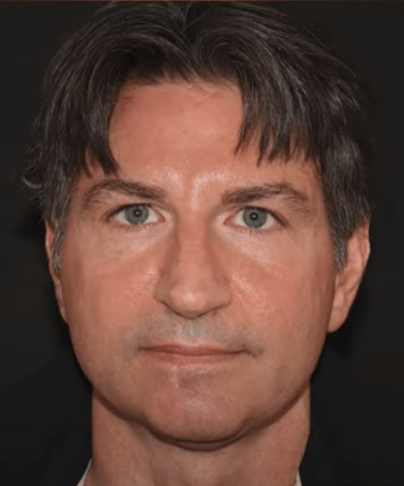 Chin Augmentation Before, undefined undefined - 3696