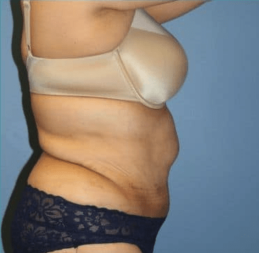 Tummy Tuck (Abdominoplasty) After, undefined undefined - 3714
