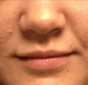 Lip Augmentation Solutions Before, undefined undefined - 3717