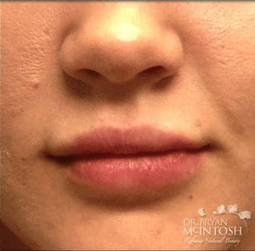 Lip Augmentation Solutions After, undefined undefined - 3717