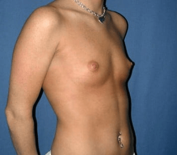 Breast Augmentation (Augmentation Mammaplasty) Before, undefined undefined - 3722