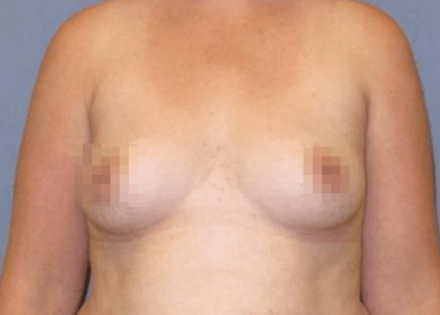 Breast Augmentation (Augmentation Mammaplasty) Before, undefined undefined - 3740