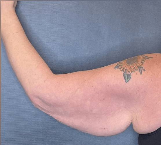 Arm Lift Before, undefined undefined - 3747