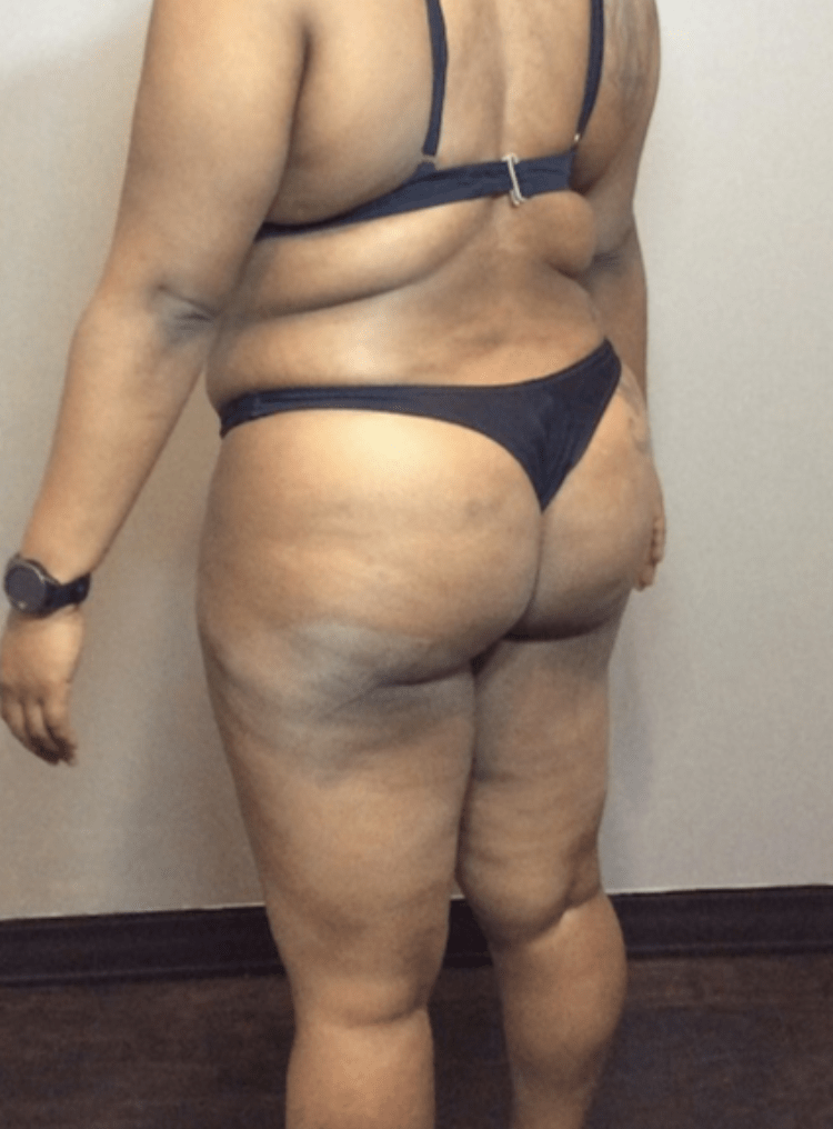 Brazilian Butt Lift Before, undefined undefined - 3750