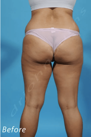 Brazilian Butt Lift Before, undefined undefined - 3752