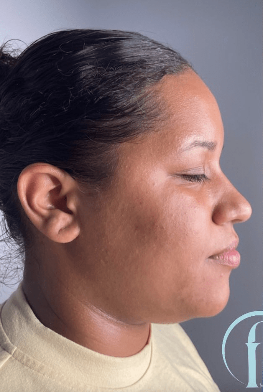 Kybella® Before, undefined undefined - 3753