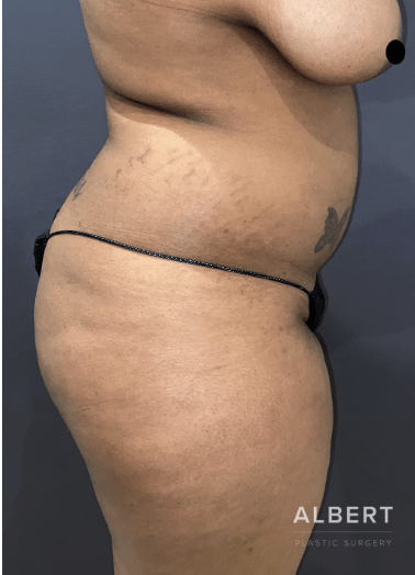 Brazilian Butt Lift Before, undefined undefined - 3762