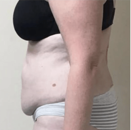 Abdominoplasty Before, undefined undefined - 3804