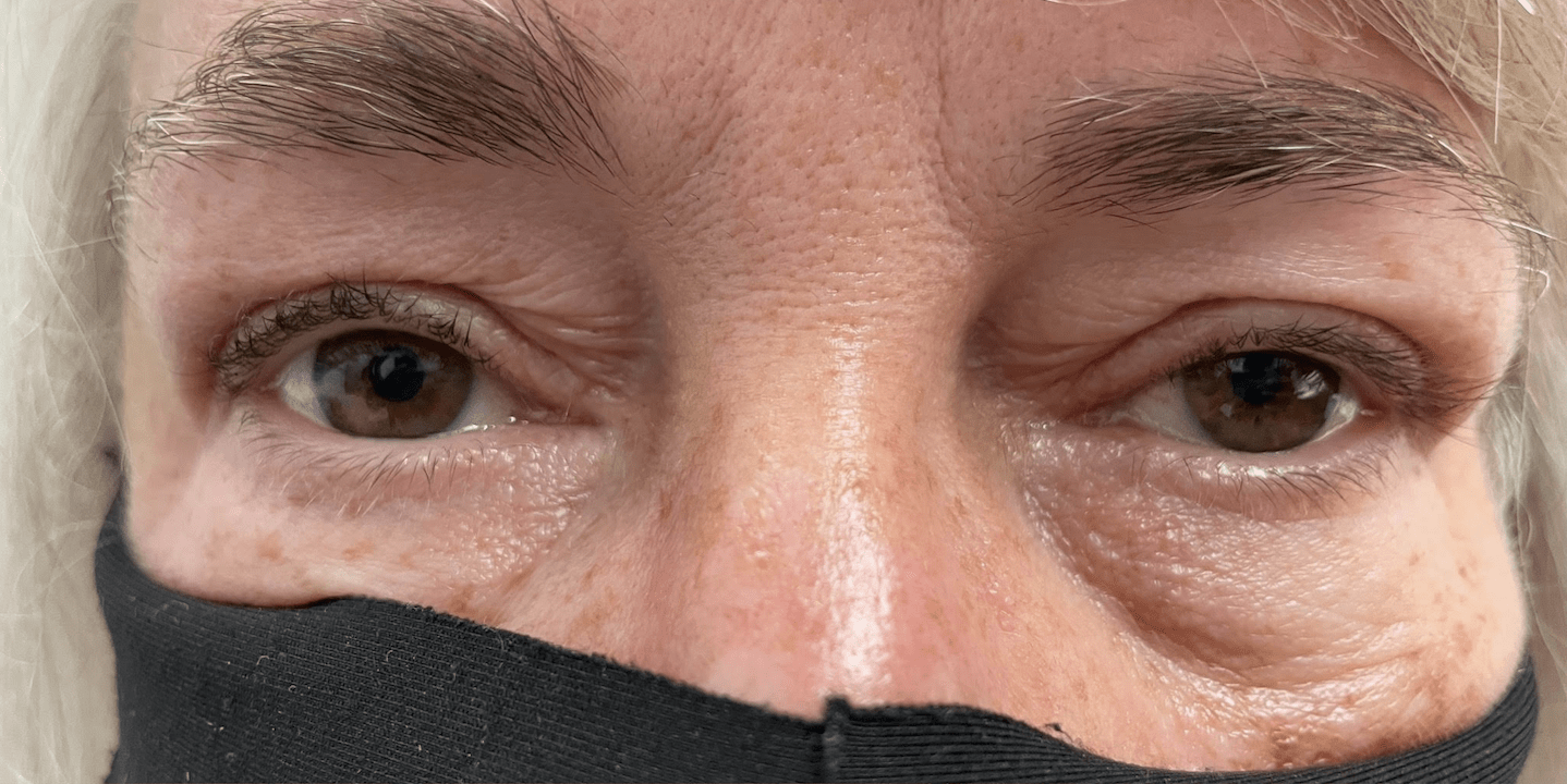 Blepharoplasty Before, undefined undefined - 3828