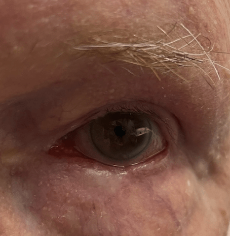 Eye Rejuvenation Solutions After, undefined undefined - 3836