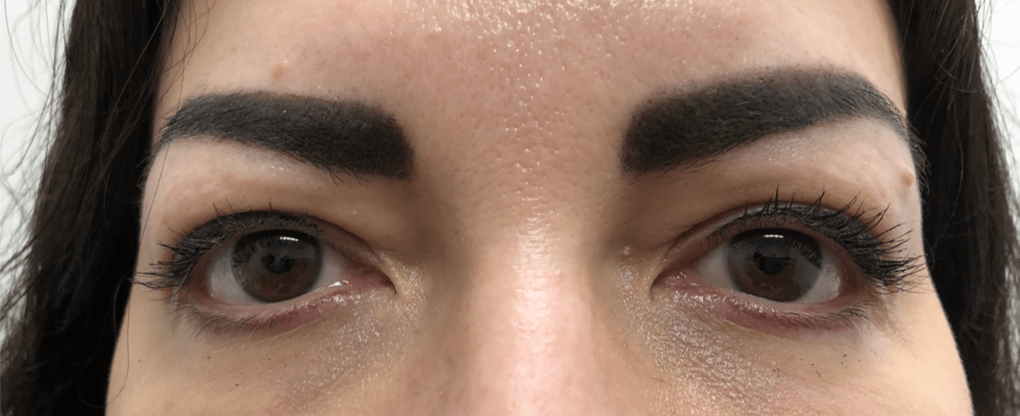 Upper Eyelid Blepharoplasty Before, undefined undefined - 3838