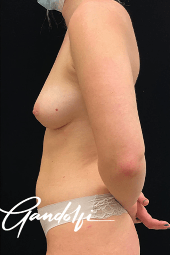 Breast Augmentation with Fat Transfer After, undefined undefined - 3841