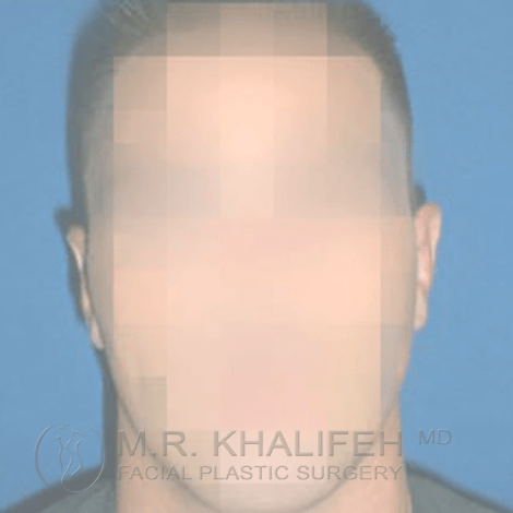 Otoplasty After, undefined undefined - 3844