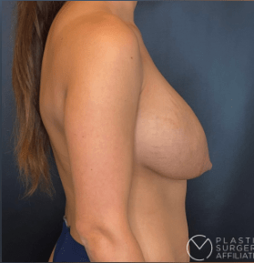 Breast Augmentation with Implants Before, undefined undefined - 3856