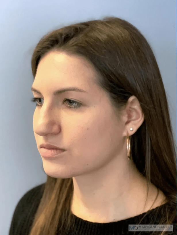 Rhinoplasty Before, undefined undefined - 3894