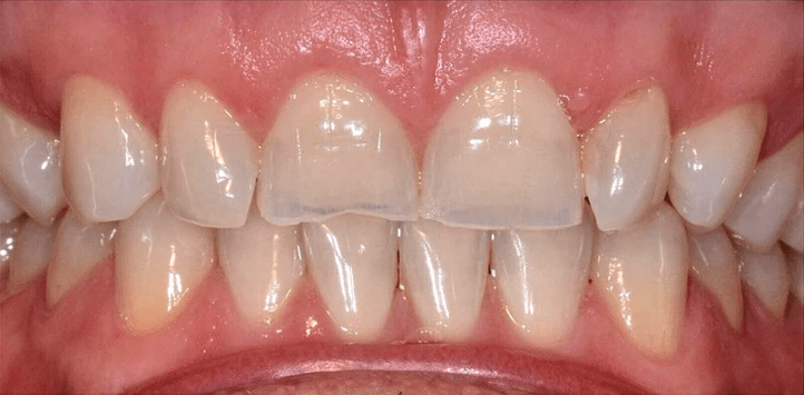 Dental Veneers Before, undefined undefined - 3901