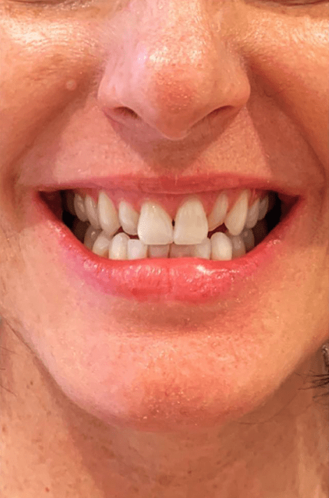 Dental Veneers Before, undefined undefined - 3983