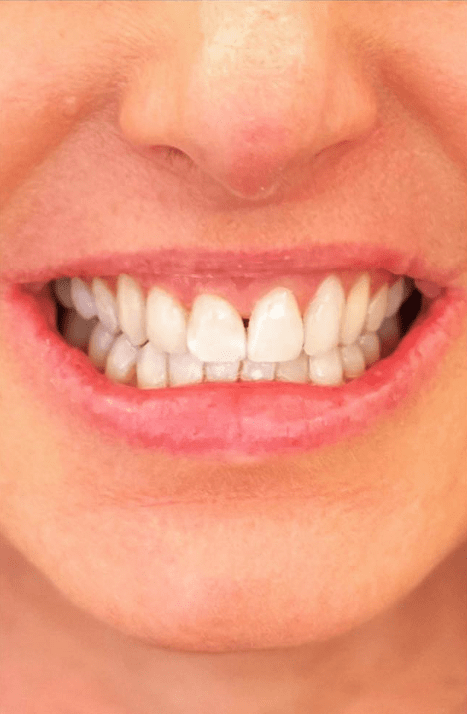 Dental Veneers After, undefined undefined - 3983