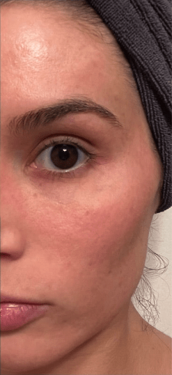 Chemical Peels After, undefined undefined - 4030