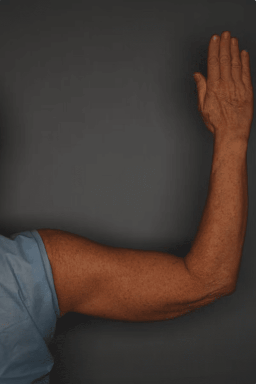 CoolSculpting® After, undefined undefined - 4039