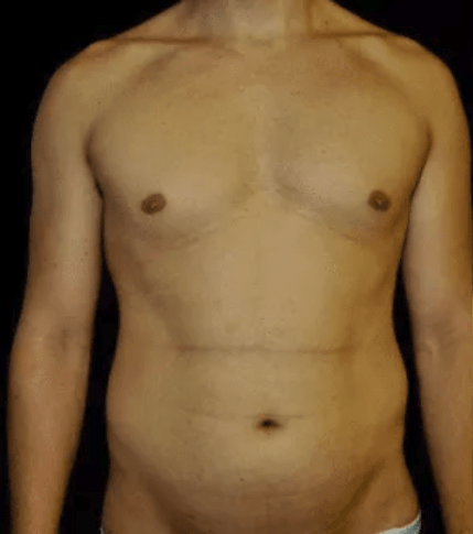 Liposuction Before, undefined undefined - 4049