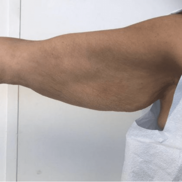 Arm Lift Before, undefined undefined - 4073
