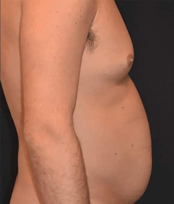 BodyTite™ Before, undefined undefined - 4102