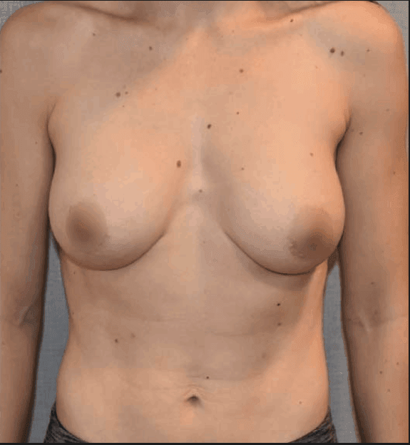 Breast Augmentation with Implants After, undefined undefined - 4109